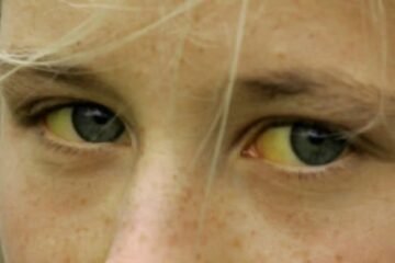 Científicos españoles ponen cara a la rara hepatitis que afecta a niños pequeños: no tiene que ver con los virus